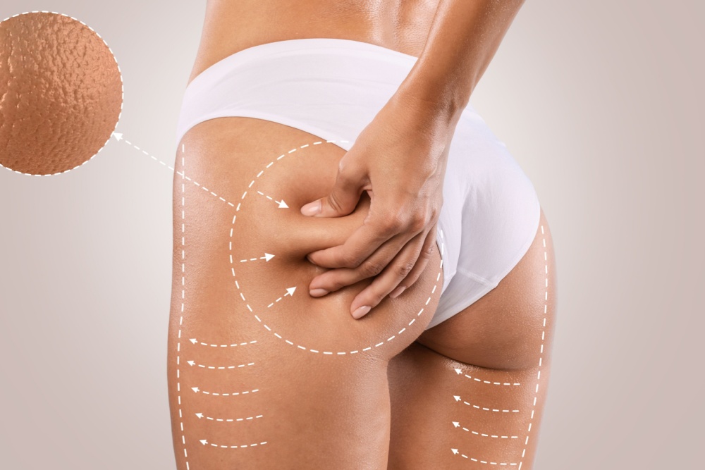 Roupas e Calçados: Como Eles Podem Impactar a Celulite - inspiração 2