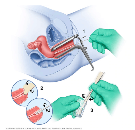 O Que Você Precisa Saber Antes do Papanicolau - inspiração 1