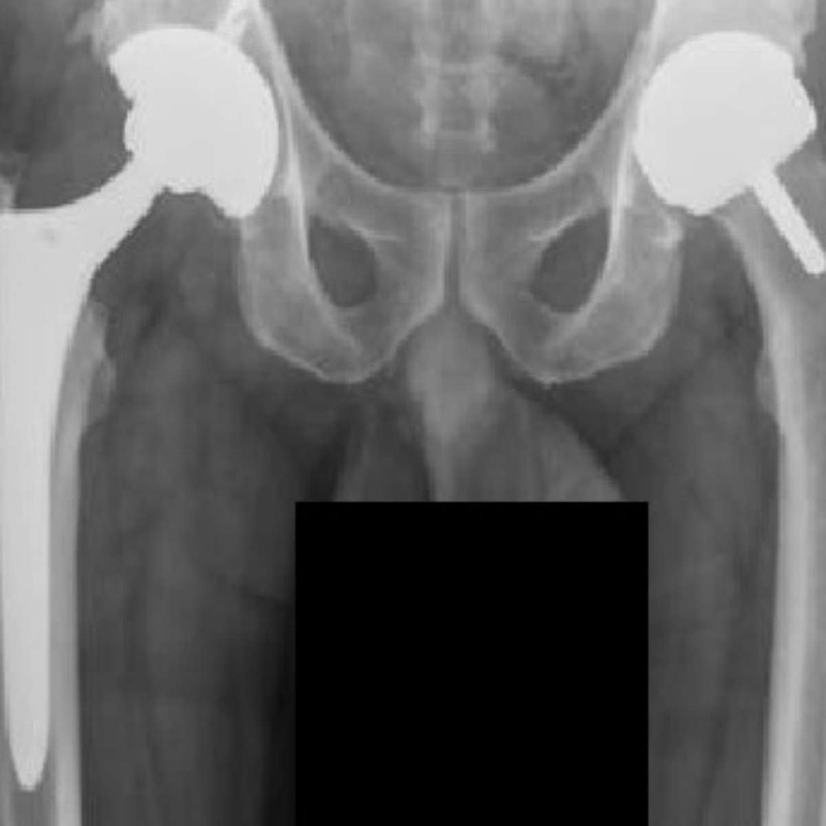 Cuidados e Manutenção de Implantes Metálicos - inspiração 2