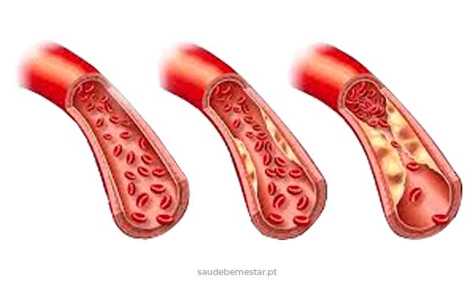 Identificando o que são triglicerídeos de forma clara - inspiração 1