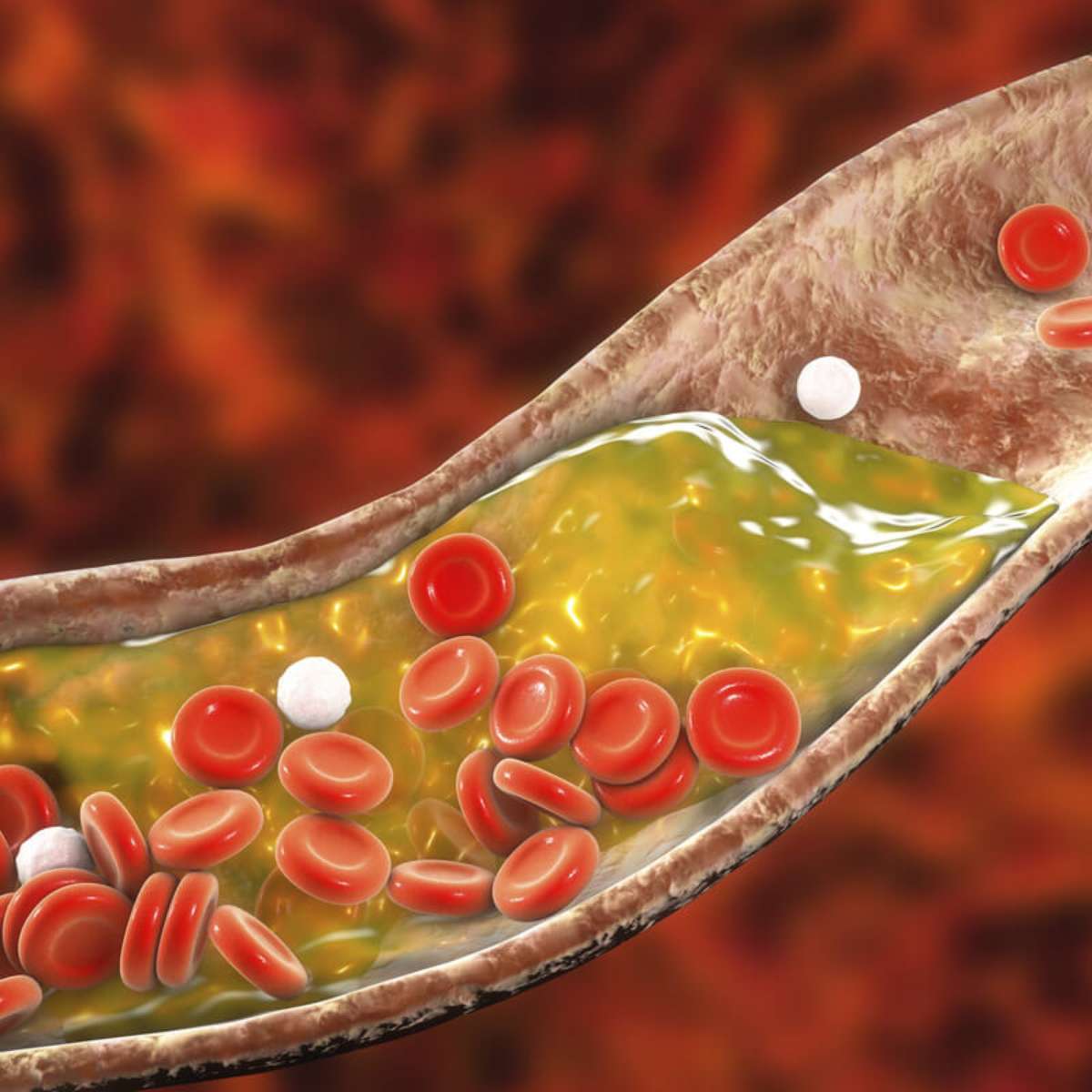 Exercícios que ajudam a baixar os triglicerídeos - inspiração 1