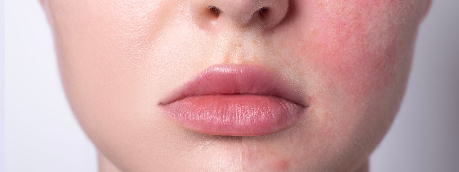 Cuidados pós-alergia: Recuperando a saúde dos lábios após reação a batom