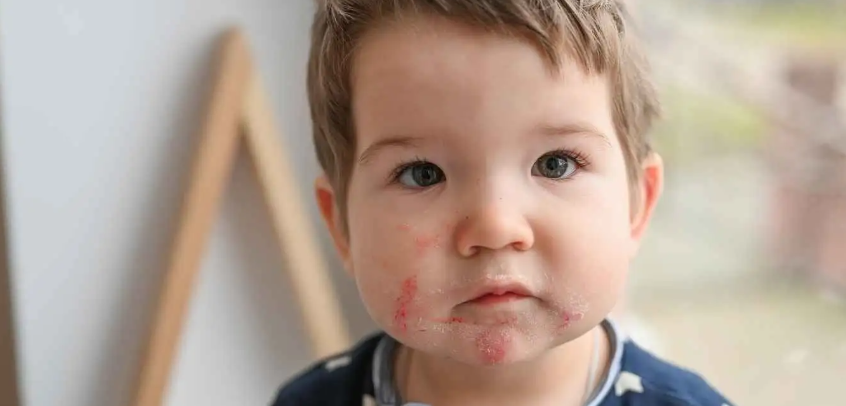 qual a diferença entre alergia ao trigo e doença celíaca