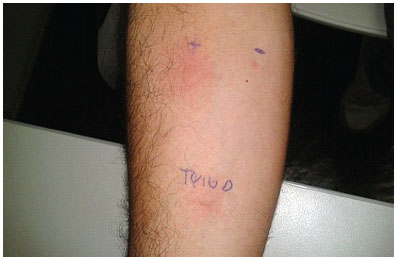 como diagnosticar alergia ao trigo