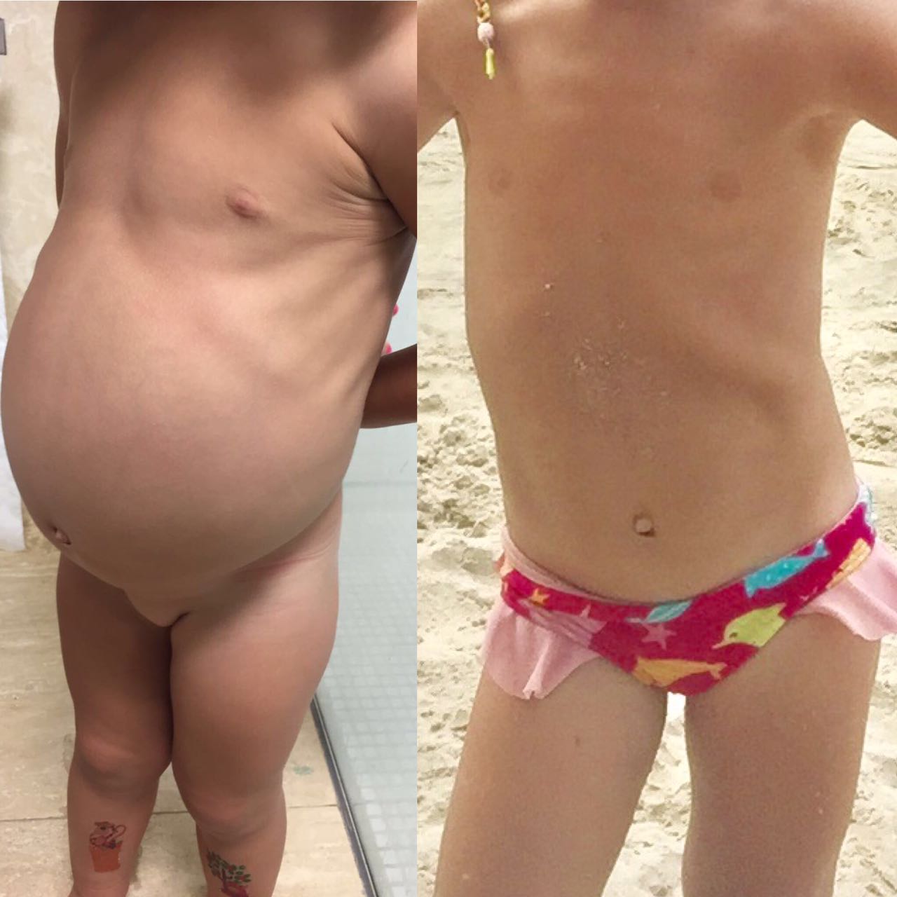 gestão de emergência para anafilaxia por trigo