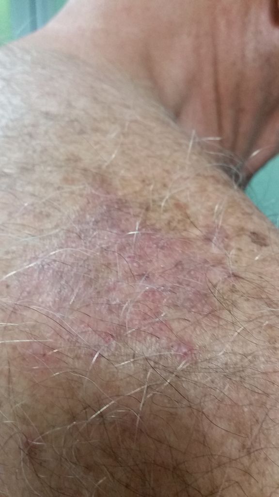 tratamento para alergia ao trigo