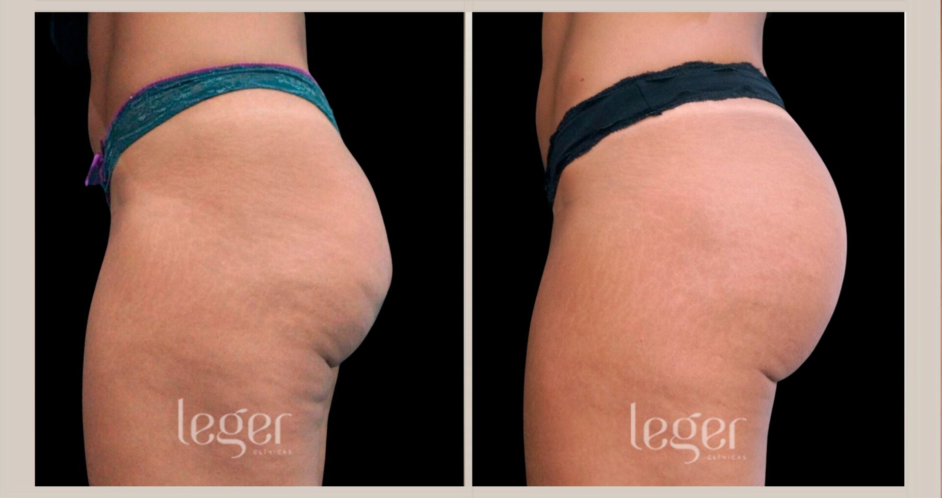 Bioestimulador de colágeno no bumbum valor