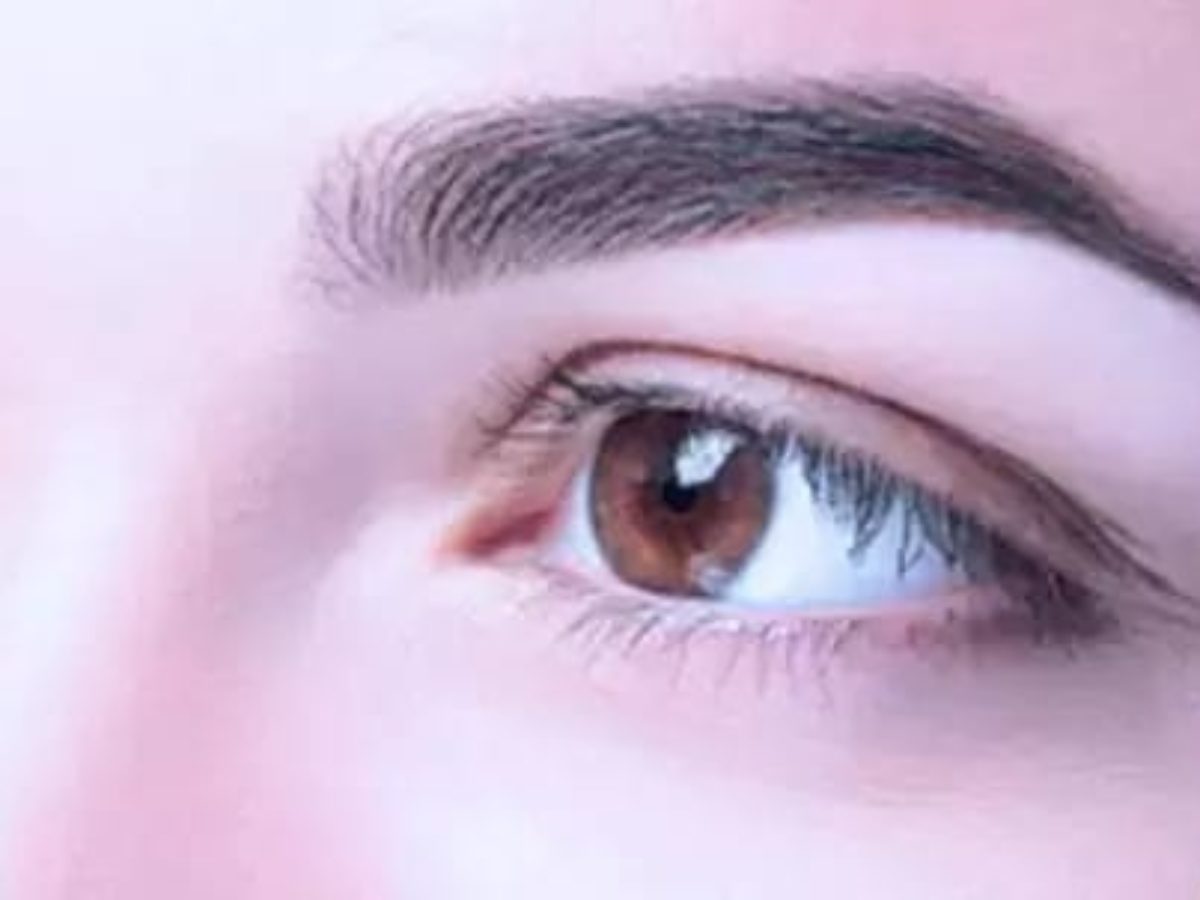 caspa na sobrancelha