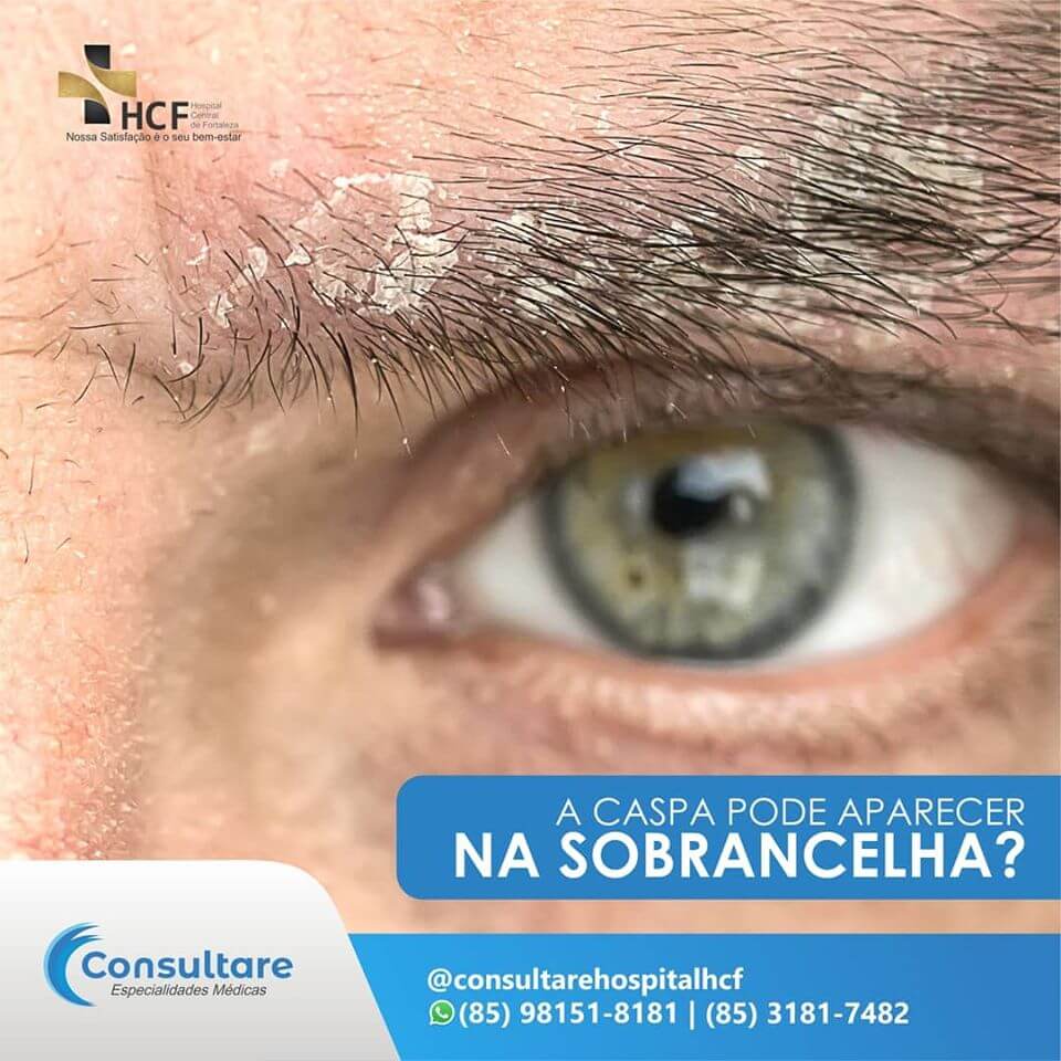 Shampoos e Cuidados Essenciais para Eliminar a Caspa nas Sobrancelhas