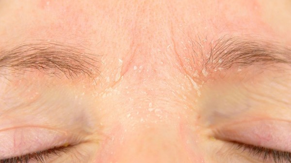 Fungo Malassezia e Caspa na Sobrancelha: O Que Você Precisa Saber