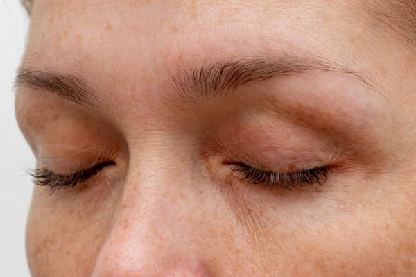 Estresse e Caspa na Sobrancelha: Entenda a Conexão e Previna Crises