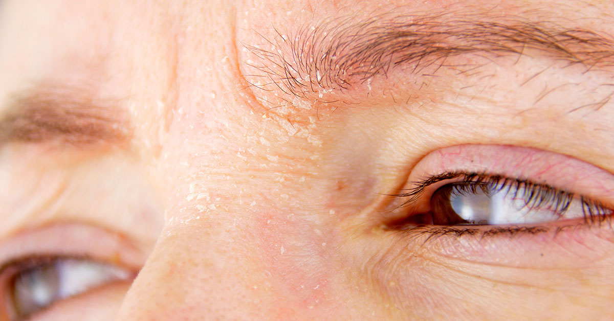 Caspa na Sobrancelha: Sintomas, Como Tratar e Quando Procurar um Médico