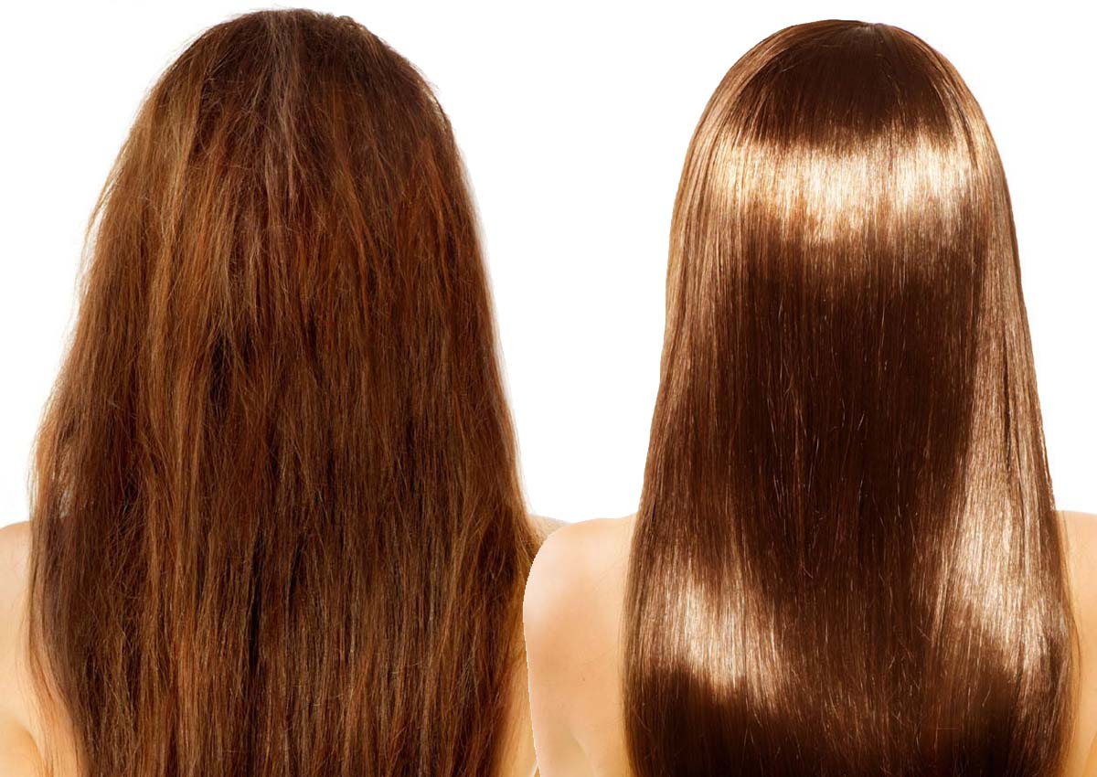 cauterização capilar