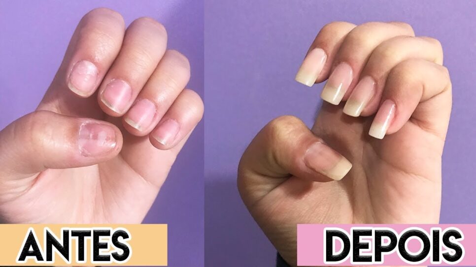 Óleo Essencial de Tea Tree: Seu Aliado Contra Micoses de Unha