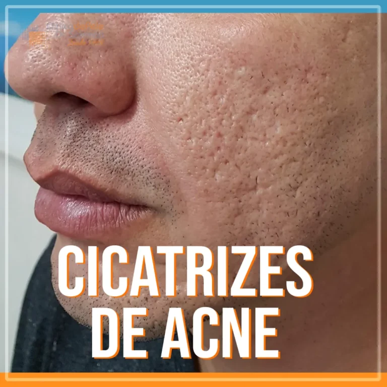 Guia Completo dos Tipos de Cicatrizes de Acne e Como Identificá-las