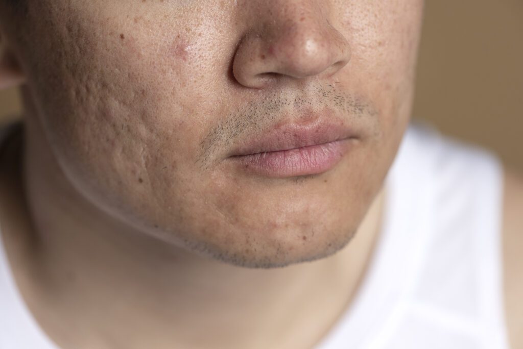 Ácidos Essenciais para o Tratamento de Cicatrizes de Acne: Retinoico