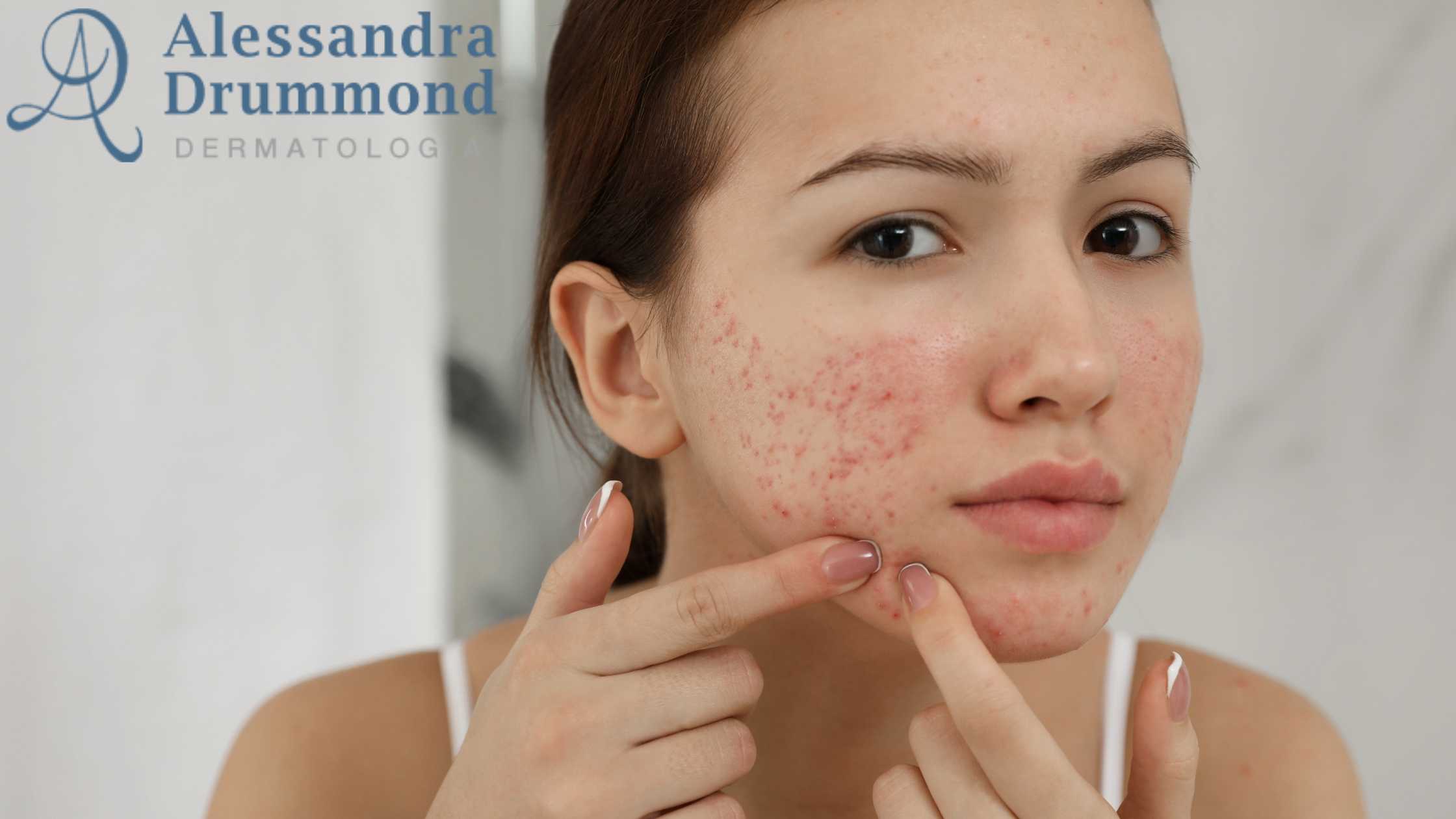 Microagulhamento e Laser: Qual o Melhor para Suas Cicatrizes de Acne?