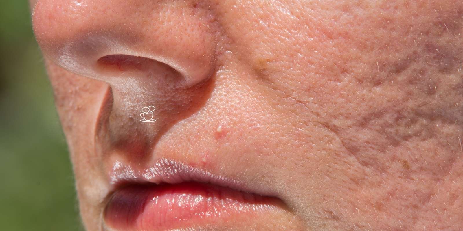 Prevenção de Cicatrizes de Acne: Dicas para Evitar Marcas Permanentes