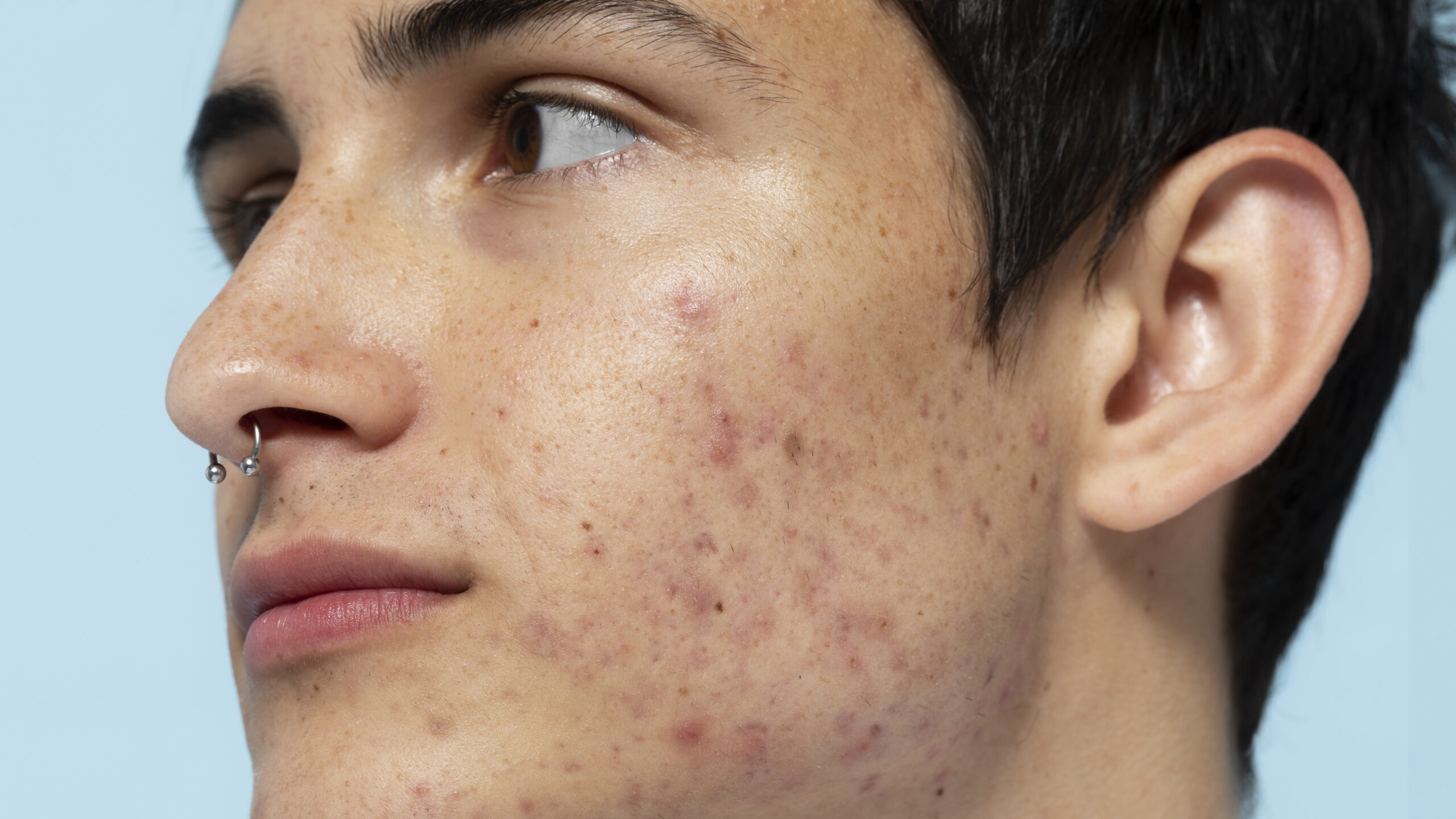 Peelings Químicos e Preenchimentos: Soluções para Cicatrizes Profundas de Acne