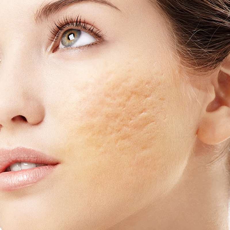 Guia Completo dos Tipos de Cicatrizes de Acne e Como Identificá-las