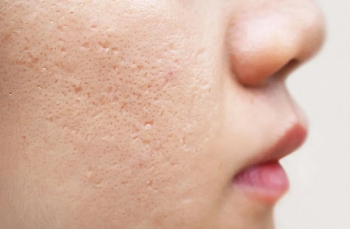 Ácidos Essenciais para o Tratamento de Cicatrizes de Acne: Retinoico