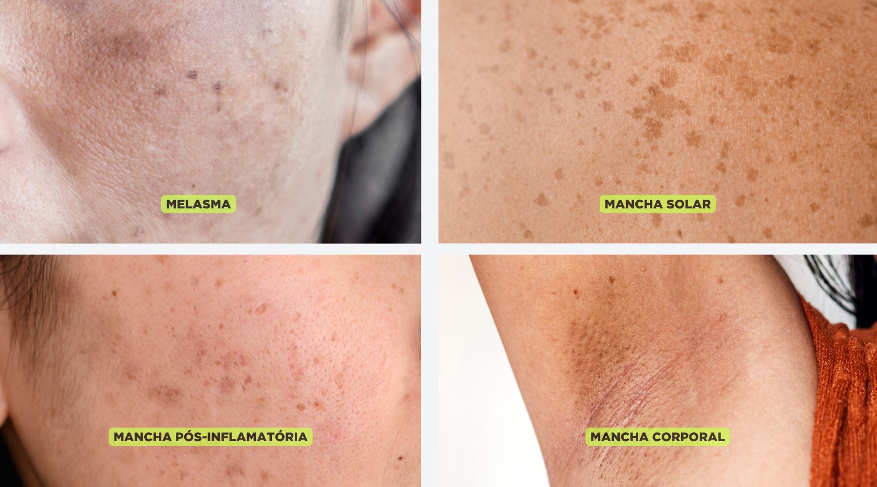 creme para manchas de sol com vitamina C