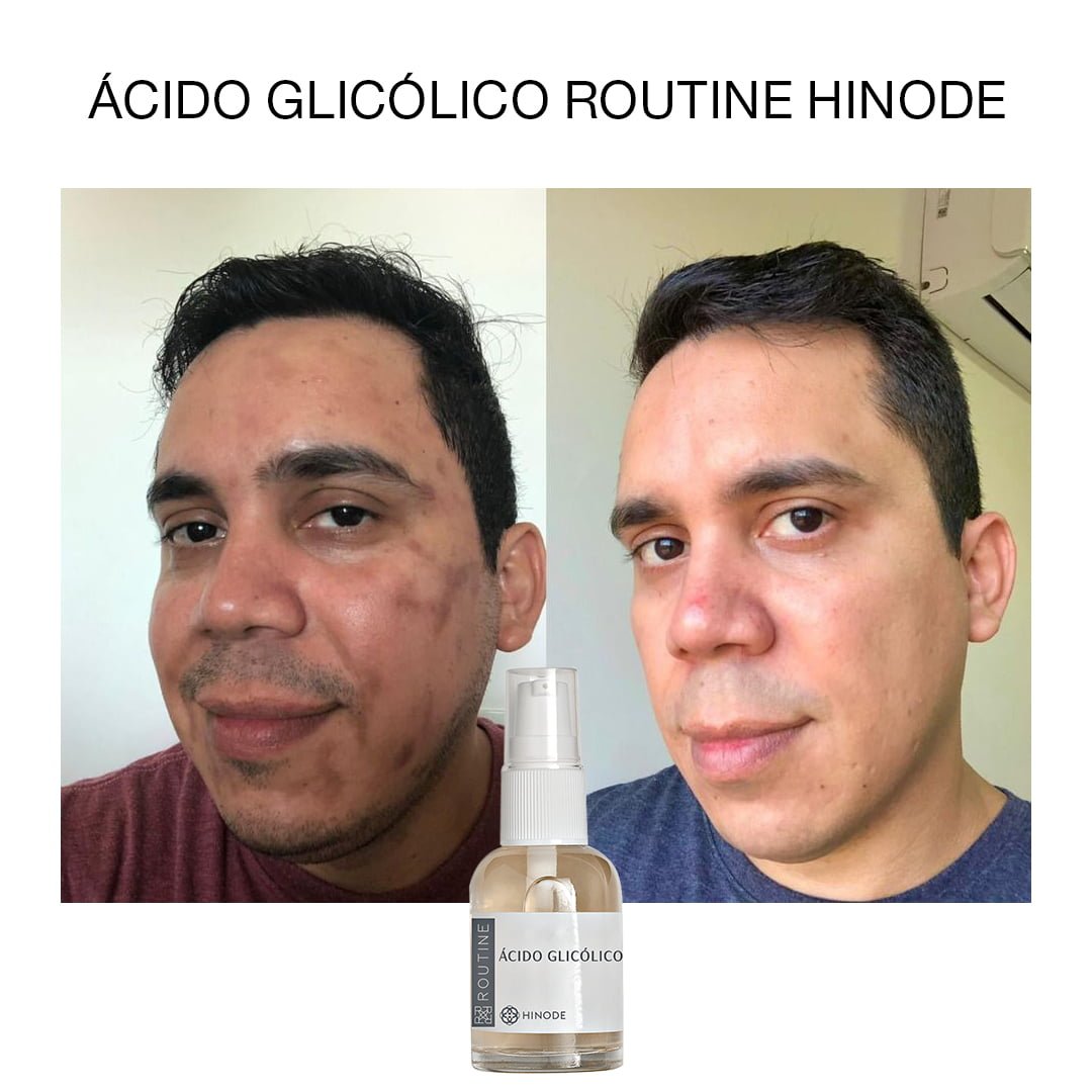 tratamento para marcas de acne e oleosidade