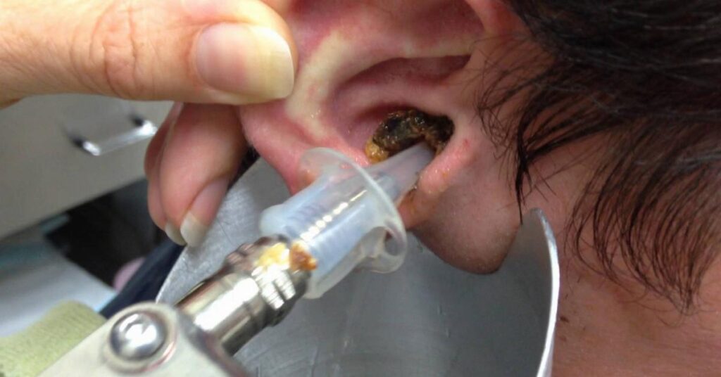 como fazer lavagem ouvido