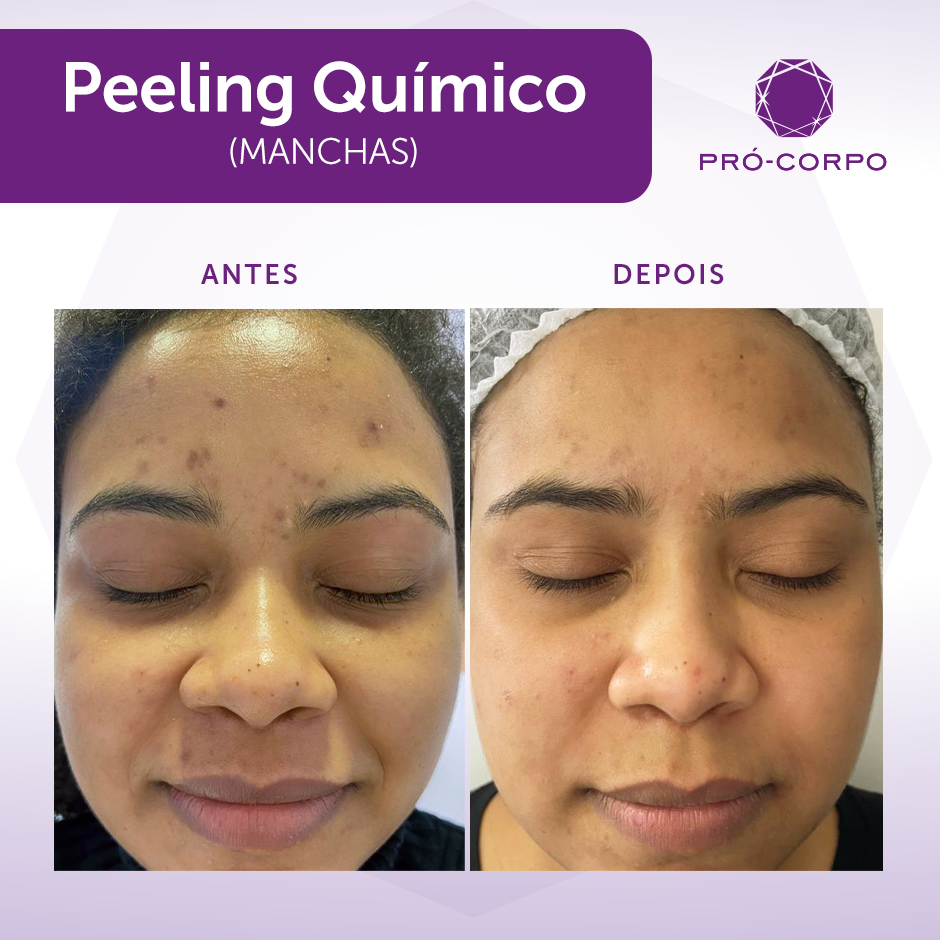 como fazer peeling em casa