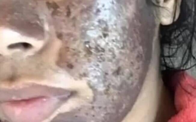 Peeling de Diamante: Como Funciona e Benefícios