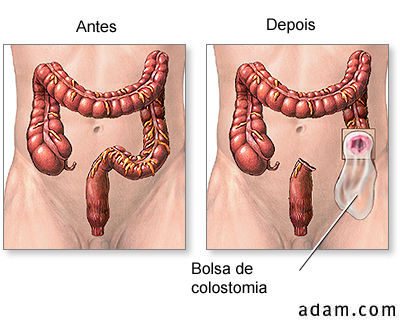 Laxantes: quando e como usar