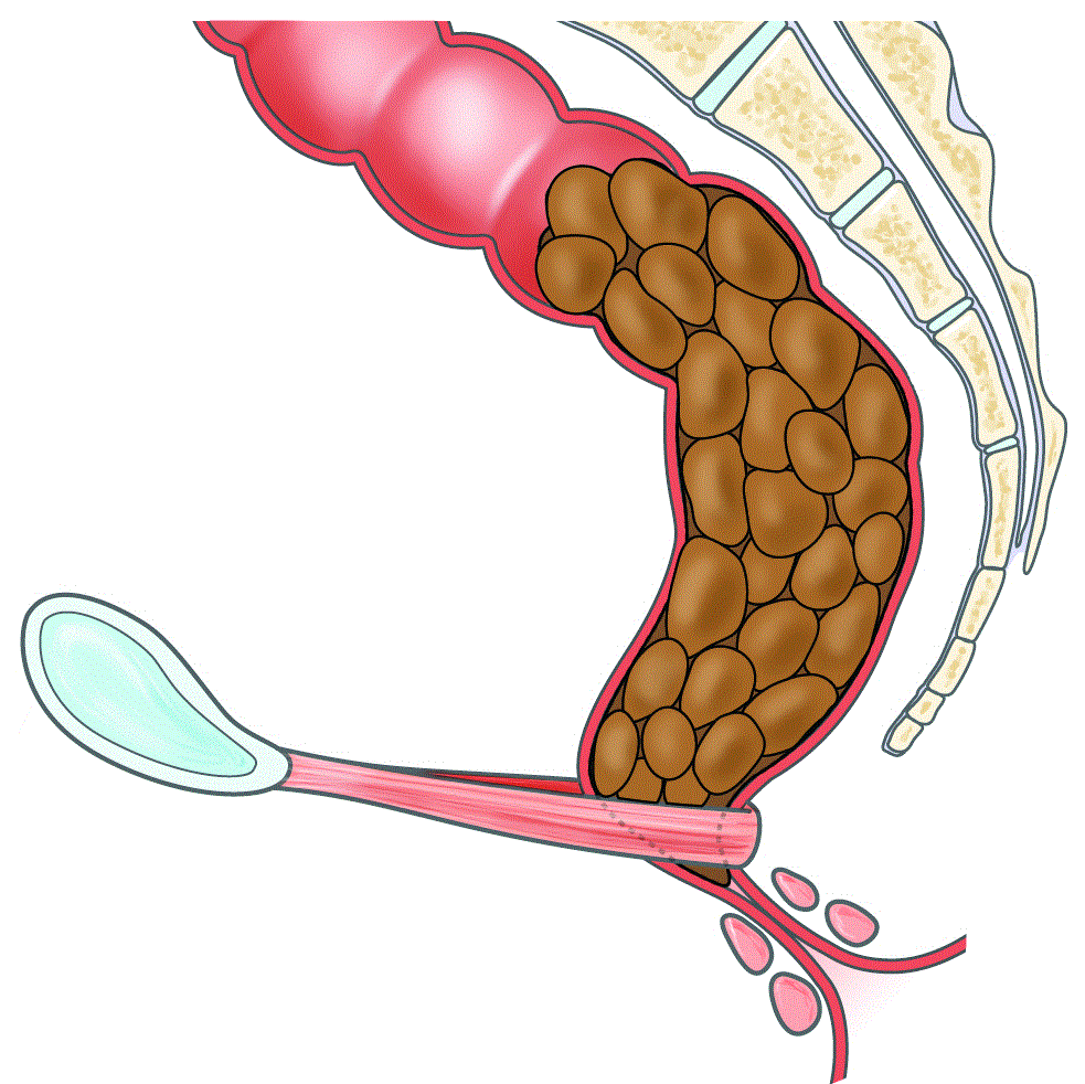 Exercícios físicos para regular o intestino