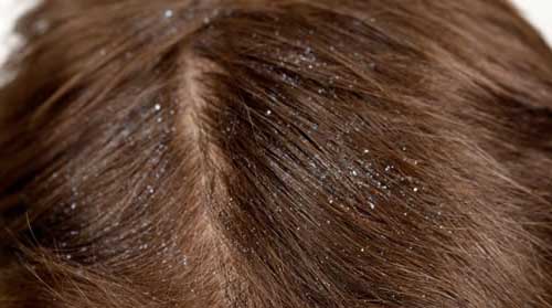 remédios caseiros para couro cabeludo seco
