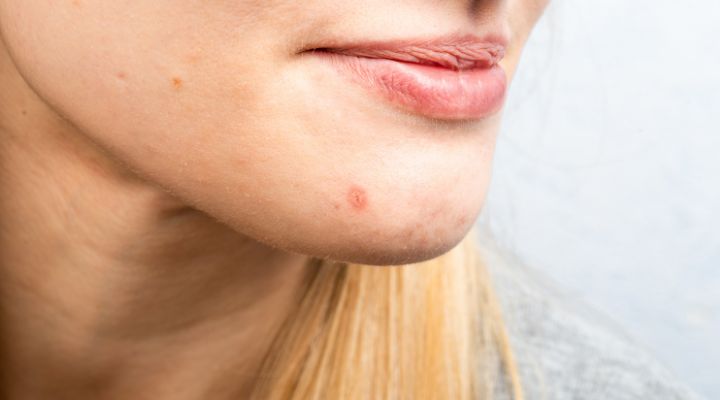 Dieta Anti-inflamatória: Alimentos para Combater a Acne no Queixo