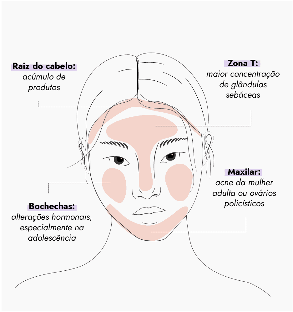 SOP e Acne: Entenda a Relação e Opções de Tratamento