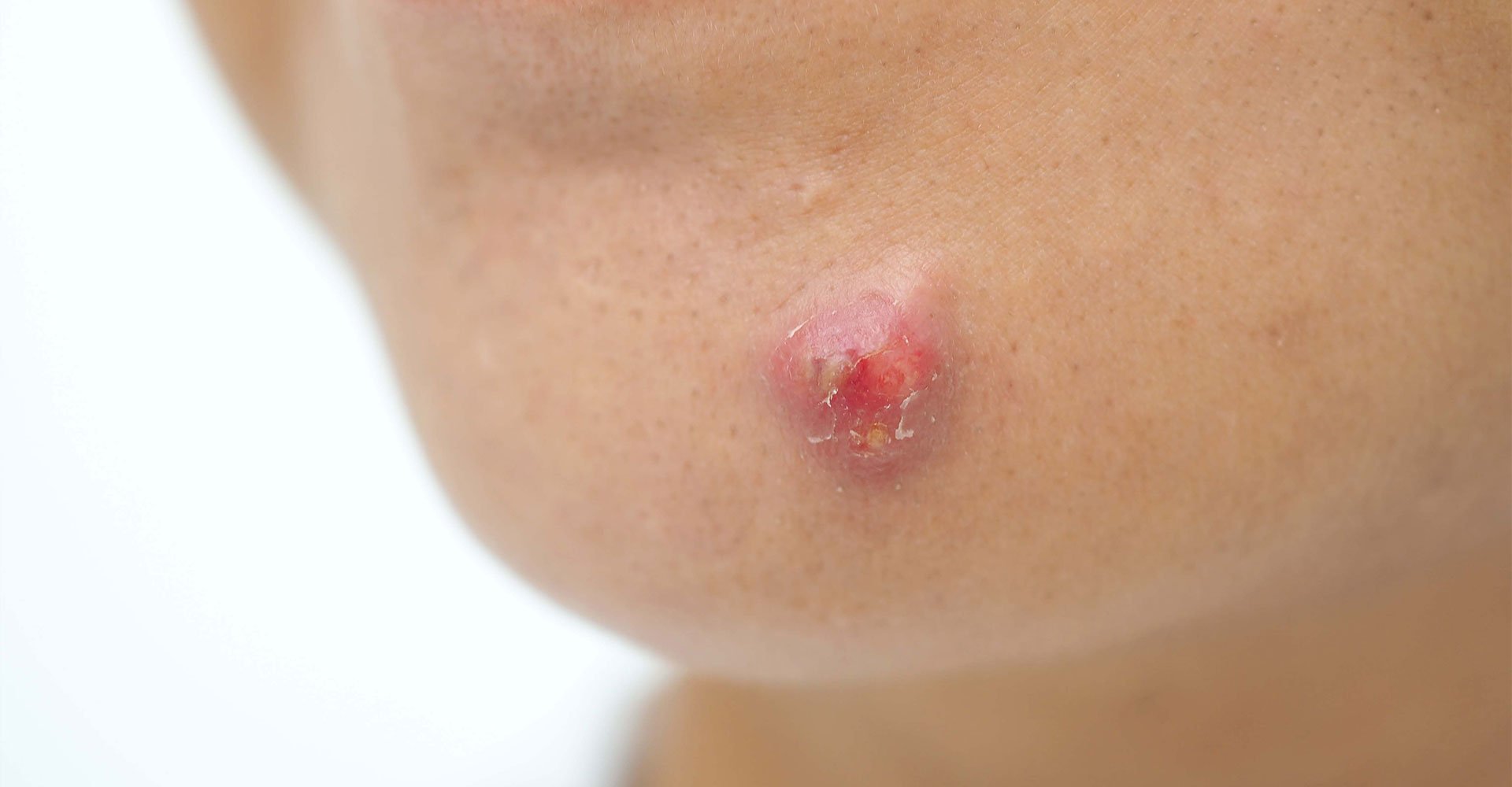 Acne Hormonal no Queixo: Como Identificar e Tratar Desequilíbrios