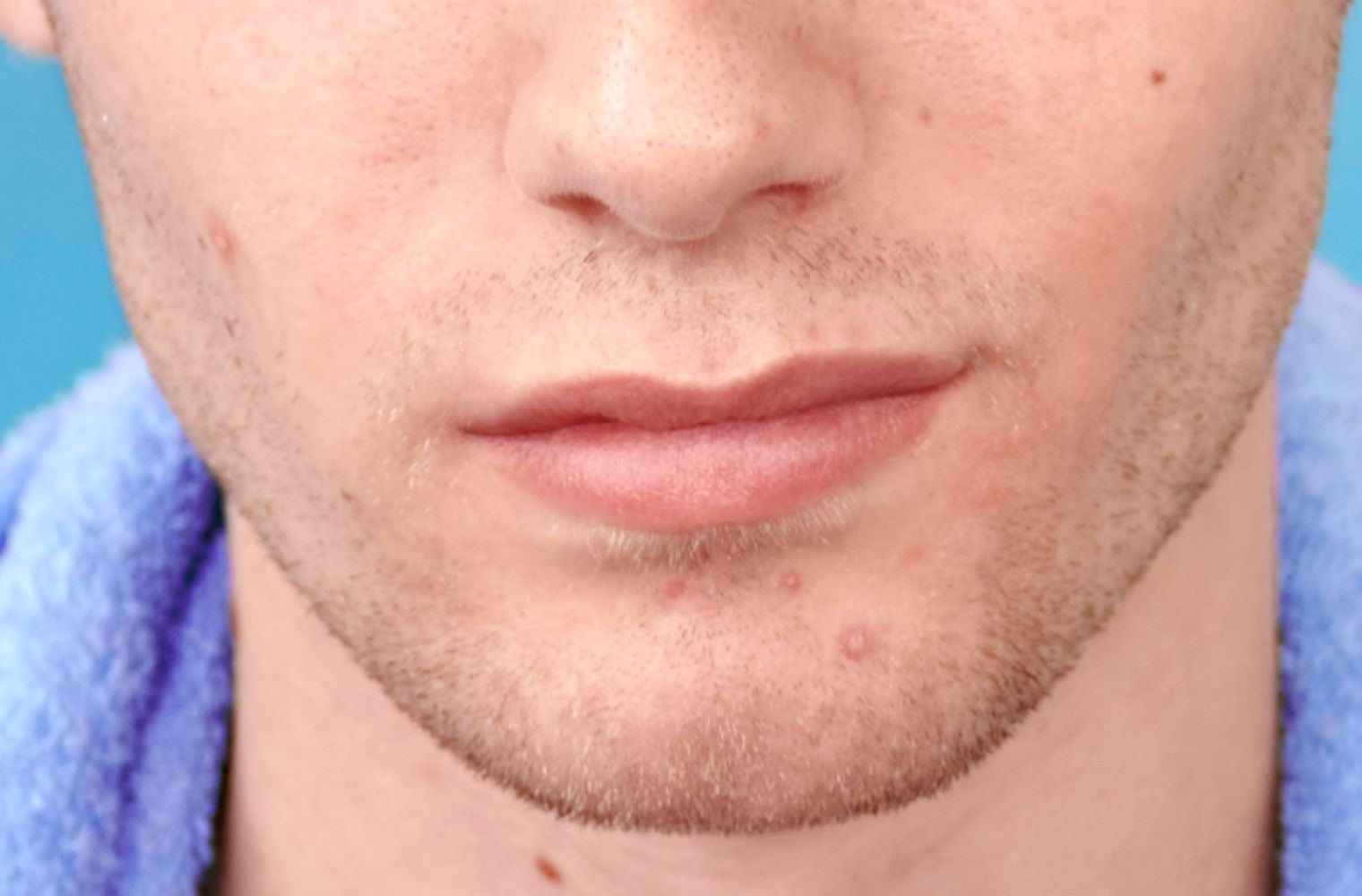 SOP e Acne: Entenda a Relação e Opções de Tratamento