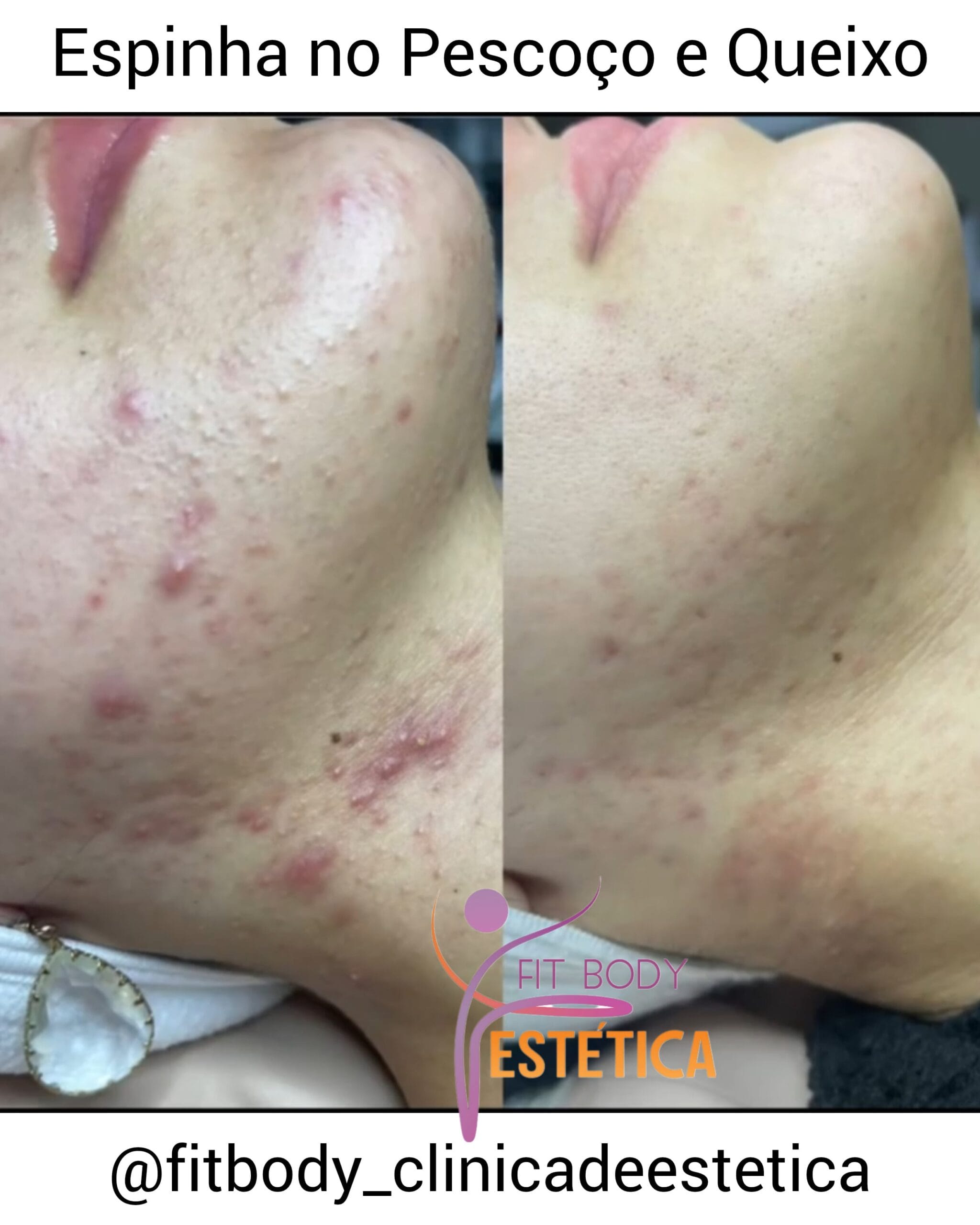 Vitamina B12 e Acne: O que Você Precisa Saber sobre Suplementação