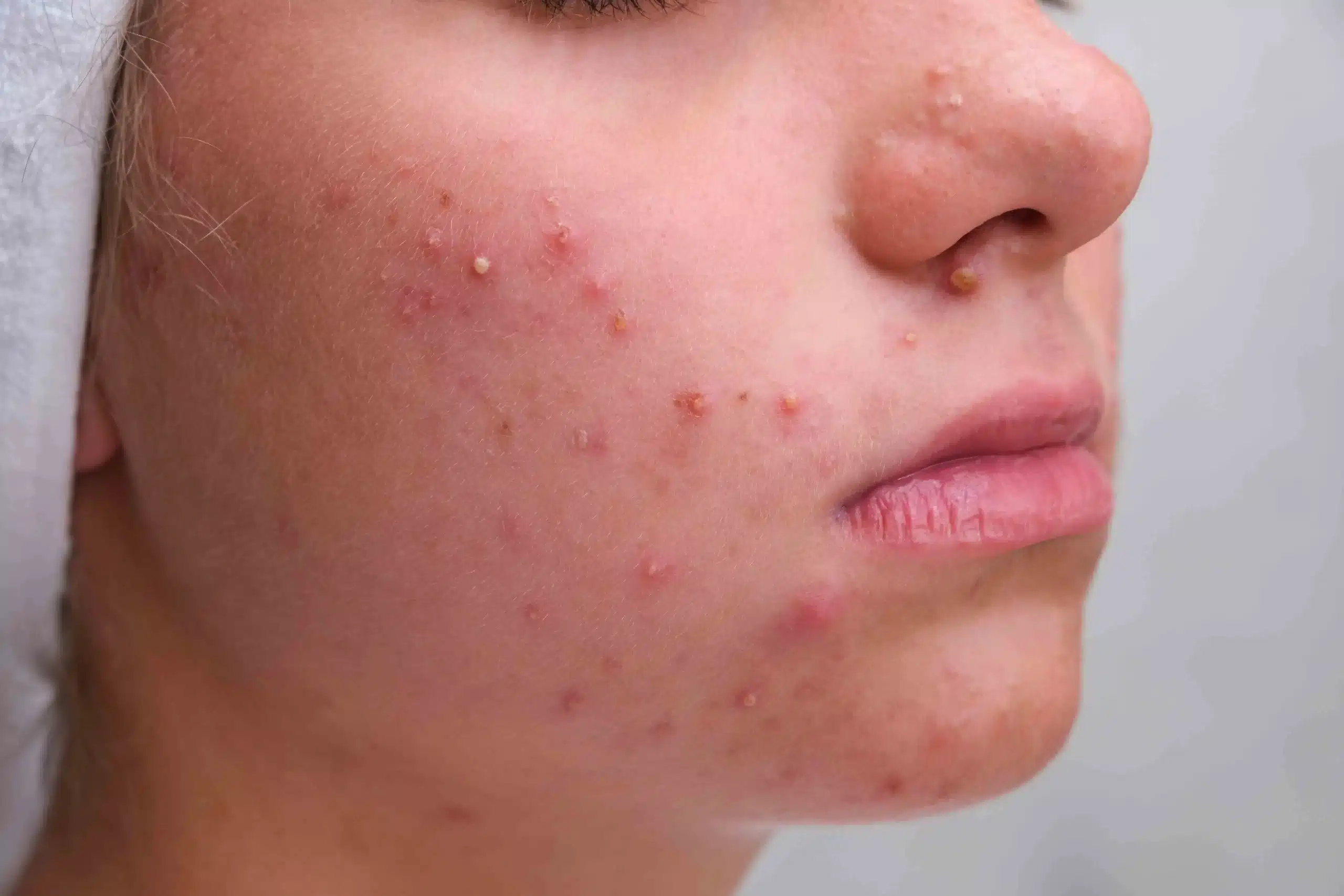 Dieta Anti-inflamatória: Alimentos para Combater a Acne no Queixo
