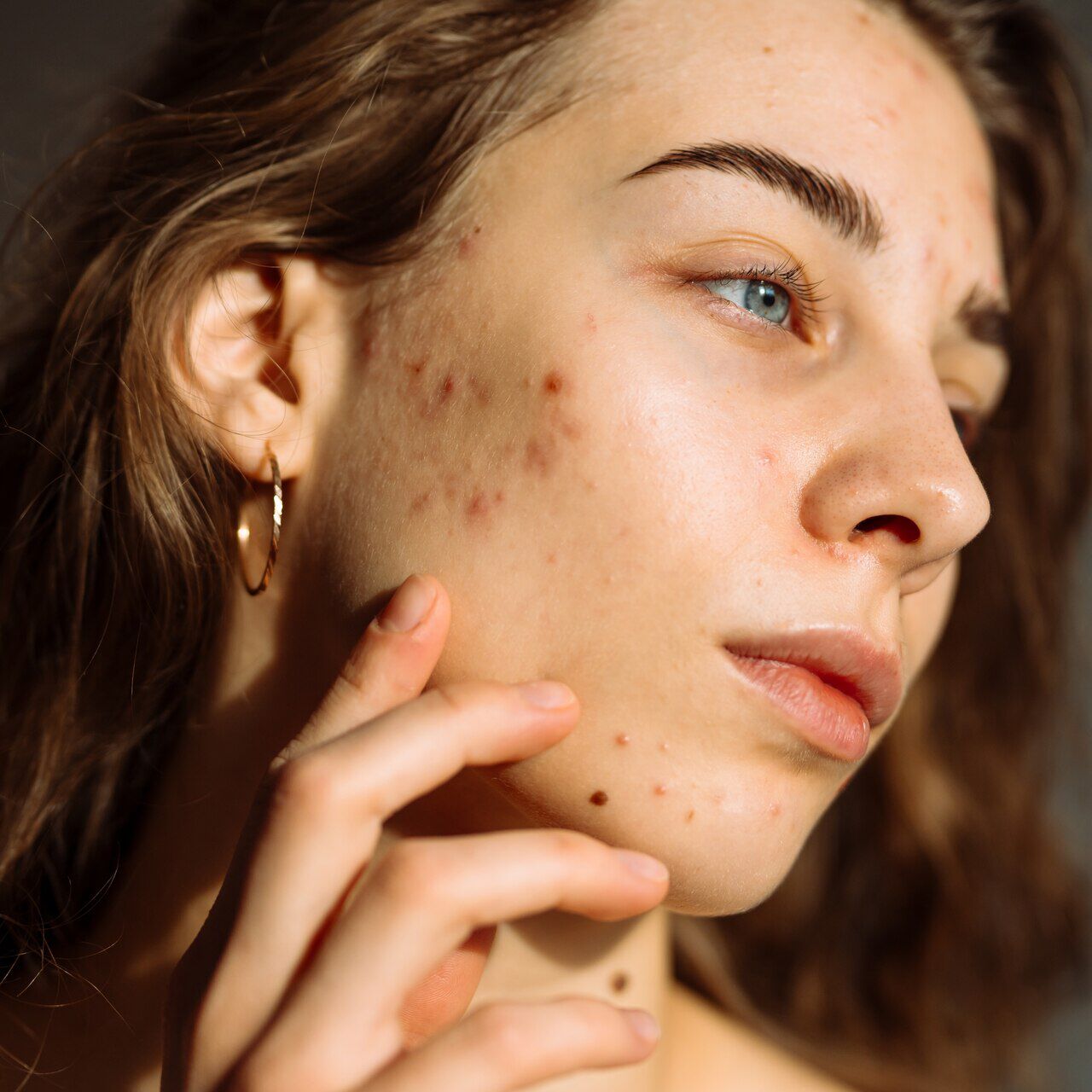 Acne Hormonal no Queixo: Como Identificar e Tratar Desequilíbrios