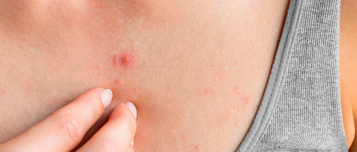 tratamento para acne persistente