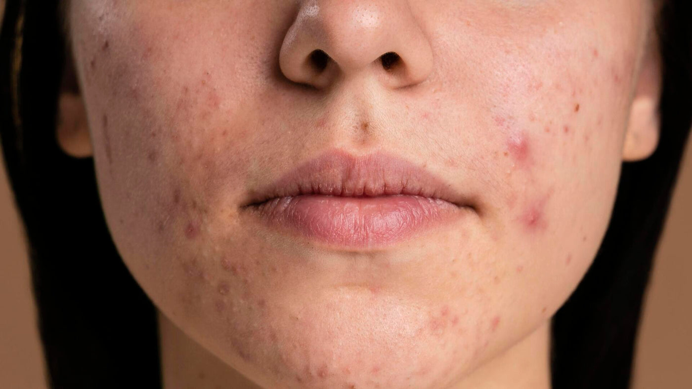 pele oleosa com espinhas o que fazer