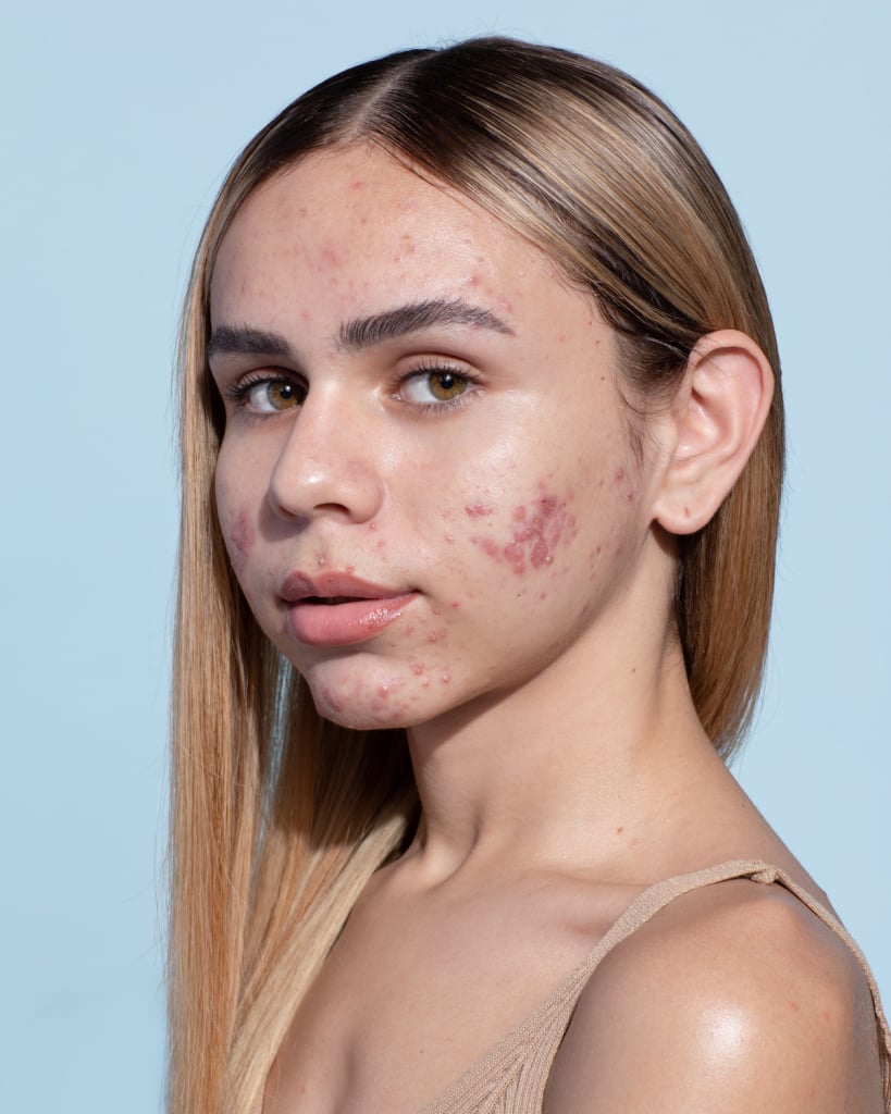 ácido salicílico para espinhas funciona