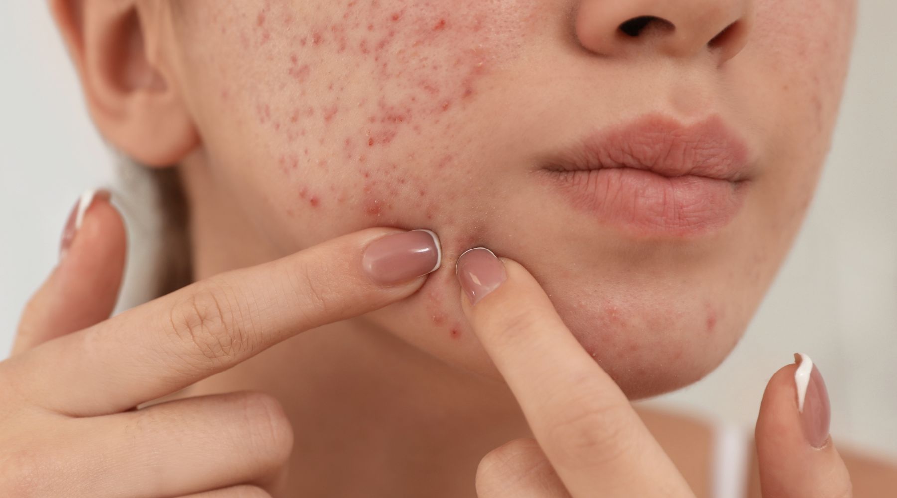 prevenção de espinhas e cravos