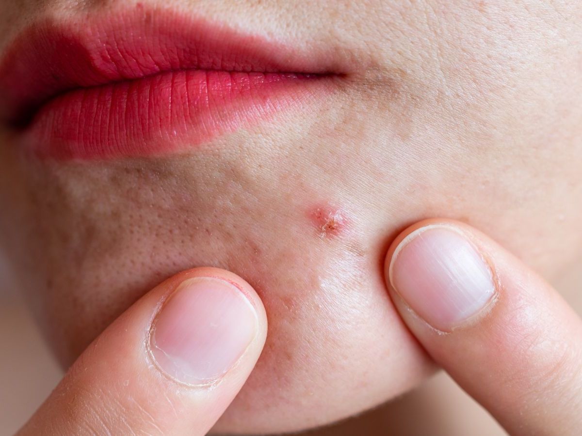 remédios caseiros para secar espinhas rápido