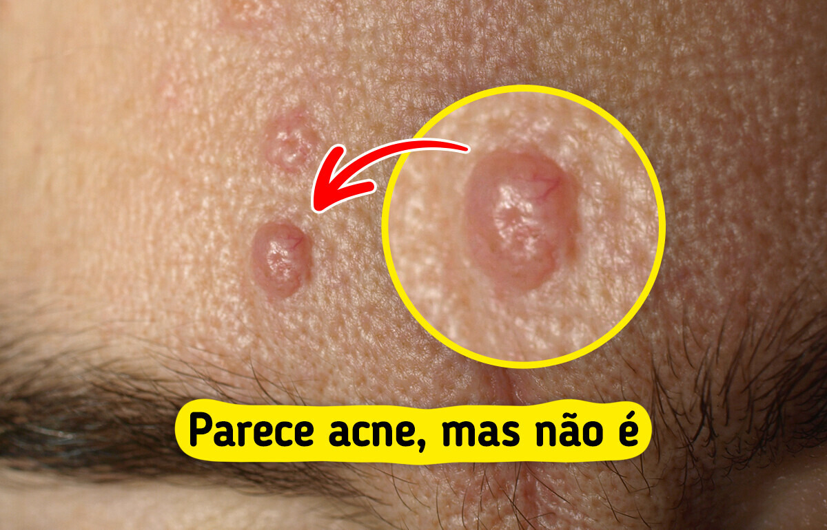 manchas de espinhas tratamento