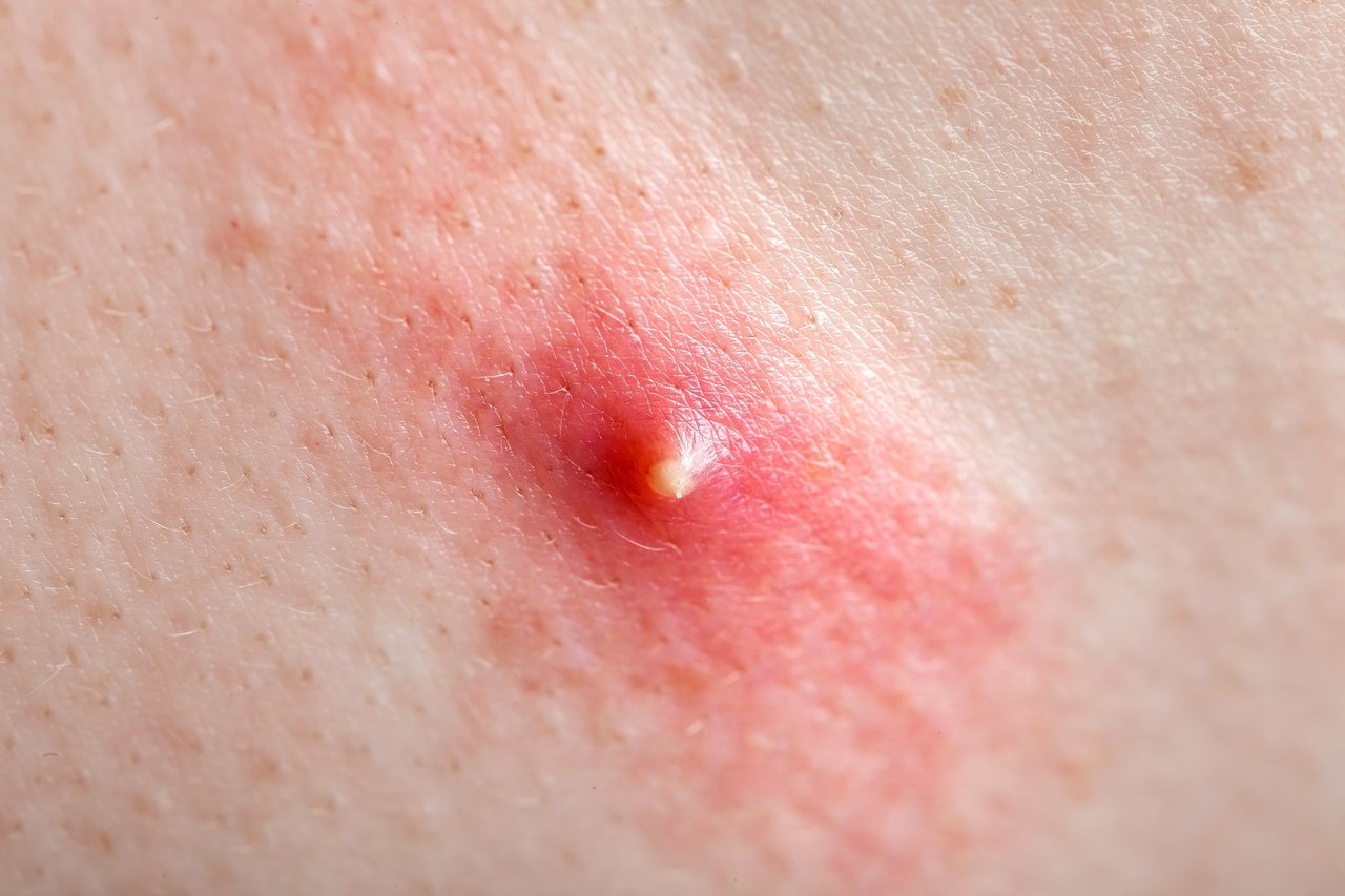 rotina de skincare para pele com acne