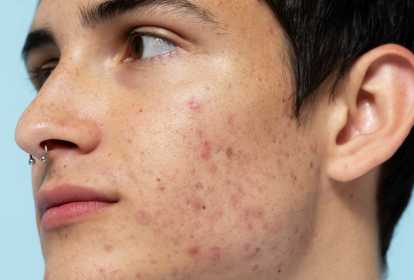 rotina de skincare para pele com acne