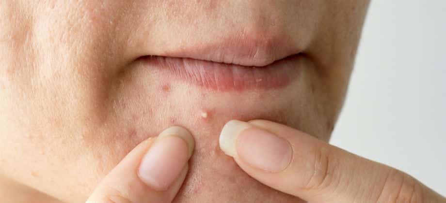 causas hormonais da acne