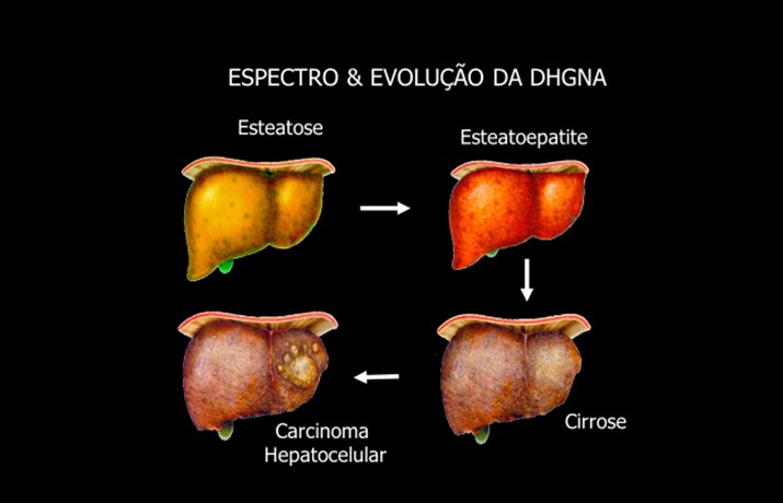 esteatose hepática
